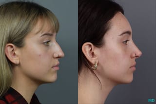 Before and after Rhinoplasty case 12317 - Angle 3
