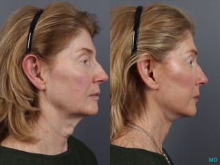 Before and after Facelift & Neck Lift case 12827 - Angle 3
