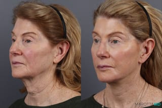 Before and after Facelift & Neck Lift case 12827 - Angle 4