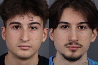 Before and after Rhinoplasty case 12828 - Angle 1