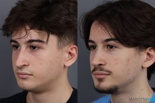 Before and after Rhinoplasty case 12828 - Angle 4