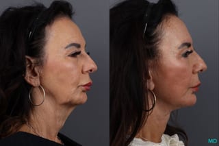 Before and after Facelift & Neck Lift case 12922 - Angle 3