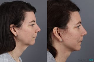 Before and after Mini Facelift case 13003 - Angle 3