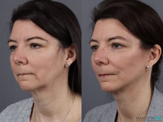 Before and after Mini Facelift case 13003 - Angle 4