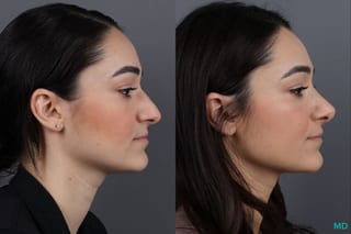 Before and after Rhinoplasty case 13004 - Angle 3