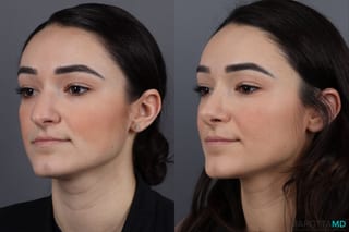 Before and after Rhinoplasty case 13004 - Angle 4