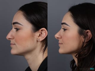 Before and after Rhinoplasty case 13004 - Angle 5