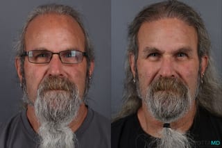 Before and after Hair Transplantation case 13186 - Angle 1