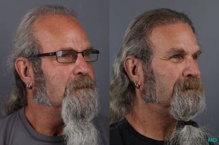 Before and after Hair Transplantation case 13186 - Angle 3