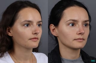 Before and after Rhinoplasty case 13237 - Angle 2