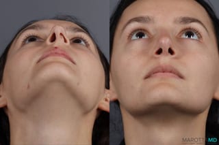 Before and after Rhinoplasty case 13237 - Angle 6