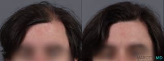 Before and after PRP Scalp Treatment case 13567 - Angle 1