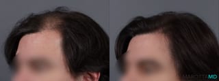 Before and after PRP Scalp Treatment case 13567 - Angle 2