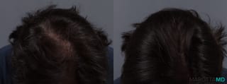 Before and after PRP Scalp Treatment case 13567 - Angle 3
