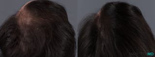 Before and after PRP Scalp Treatment case 13567 - Angle 4