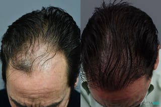 Before and after Hair Transplantation case 13569 - Angle 4