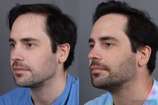 Before and after PRP Scalp Treatment case 13570 - Angle 2