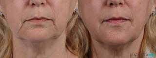 Before and after Filler - Marionette Lines case 14122 - Angle 1
