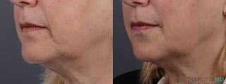 Before and after Filler - Marionette Lines case 14122 - Angle 3