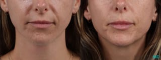 Before and after Lip Filler case 14124 - Angle 1
