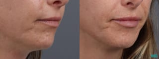 Before and after Lip Filler case 14124 - Angle 2
