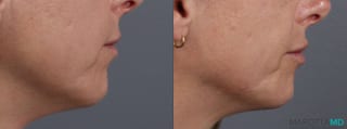 Before and after Lip Filler case 14124 - Angle 3
