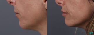Before and after Lip Filler case 14124 - Angle 5