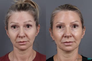 Before and after Botox - Crow's Feet case 14129 - Angle 2