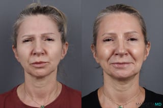 Before and after Botox - Crow's Feet case 14129 - Angle 3