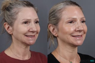 Before and after Botox - Crow's Feet case 14129 - Angle 4