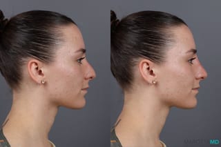Before and after Non-Surgical Rhinoplasty case 16100 - Angle 4