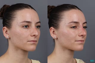 Before and after Non-Surgical Rhinoplasty case 16100 - Angle 3