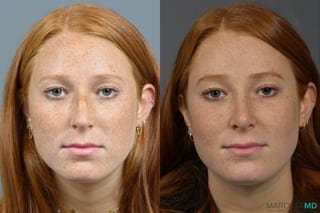 Before and after Rhinoplasty case 16102 - Angle 1