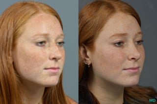 Before and after Rhinoplasty case 16102 - Angle 2