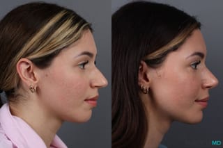 Before and after Rhinoplasty case 17177 - Angle 3
