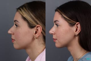Before and after Rhinoplasty case 17177 - Angle 5