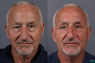 Before and after Blepharoplasty Lower case 17403 - Angle 1
