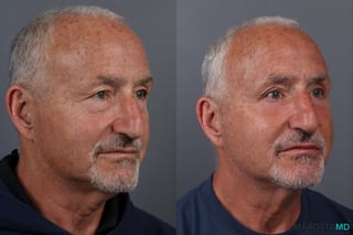 Before and after Blepharoplasty Lower case 17403 - Angle 2
