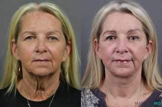 Before and after Laser Skin Resurfacing - Face case 17405 - Angle 1