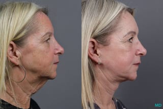 Before and after Laser Skin Resurfacing - Face case 17405 - Angle 3