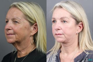 Before and after Laser Skin Resurfacing - Face case 17405 - Angle 4