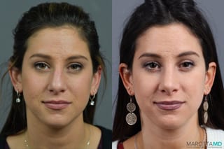 Before and after Rhinoplasty case 17407 - Angle 1