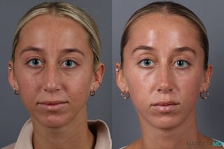 Before and after Rhinoplasty case 18368 - Angle 1