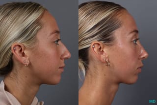 Before and after Rhinoplasty case 18368 - Angle 3