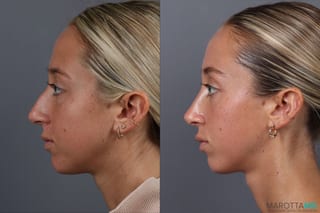 Before and after Rhinoplasty case 18368 - Angle 5