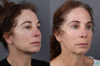 Before and after Blepharoplasty Upper case 18372 - Angle 2