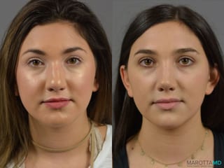 Before and after Rhinoplasty case 18387 - Angle 1