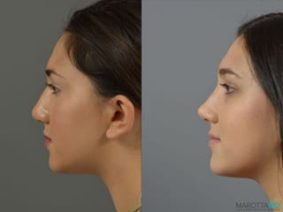 Before and after Rhinoplasty case 18387 - Angle 2