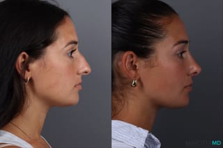 Before and after Rhinoplasty case 19687 - Angle 3