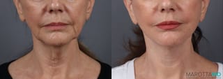 Before and after Facelift & Neck Lift case 19692 - Angle 1